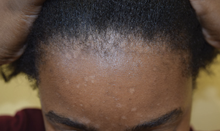 Hypopigmented macule and patches on the face of an African American female with seborrheic dermatitis
