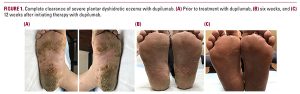 Dyshidrotic eczema picture on the soles of feet