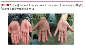 Dyshidrotic eczema picture of the hands