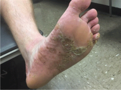 Dyshidrotic eczema picture on the sole of the foot